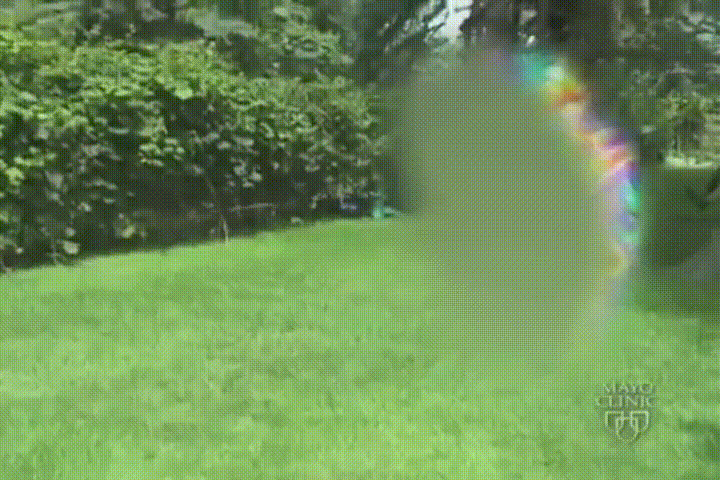 migraine aura myelin nystagmus