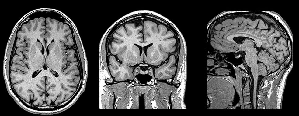 MRI scan does not identify fybromyalgia